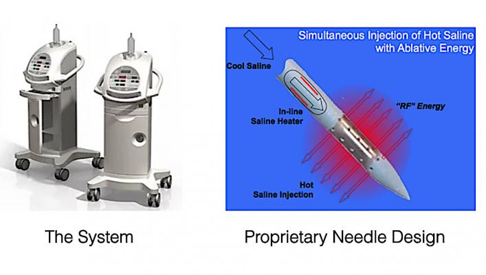 Saline Enhanced Radiofrequency Ablation May be an Effective Method